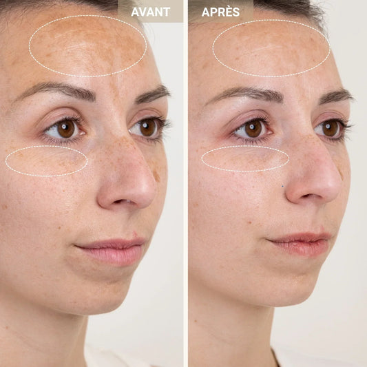 Acide salicylique : les étonnants bienfaits du BHA pour purifier la peau et réduire les imperfections