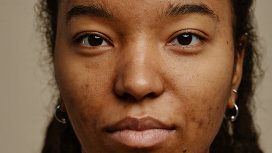 Hyperpigmentation : origines et traitement des taches de la peau