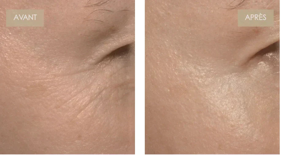 Votre guide de la luminothérapie rouge pour la zone sous les yeux