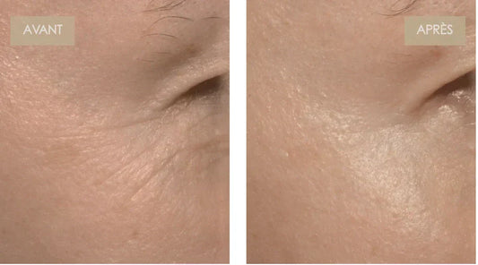 Votre guide de la luminothérapie rouge pour la zone sous les yeux