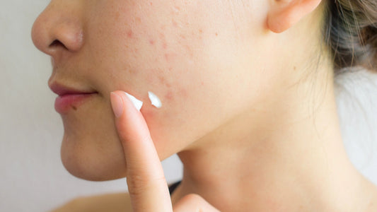 Les crèmes et sérums qui améliorent l'apparence des cicatrices d'acné