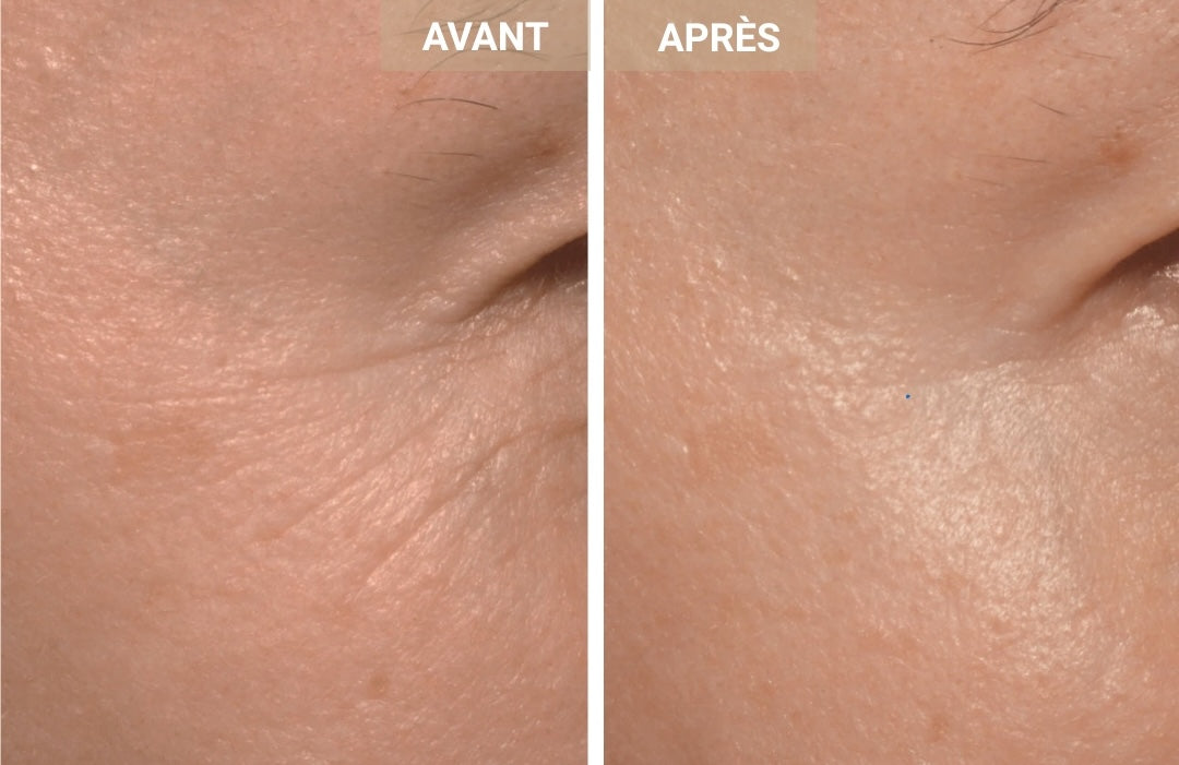 Comment la photobiomodulation offre de véritables résultats anti-âge : avant/après non retouchés