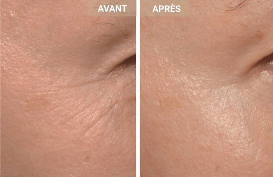 Comment la photobiomodulation offre de véritables résultats anti-âge : avant/après non retouchés
