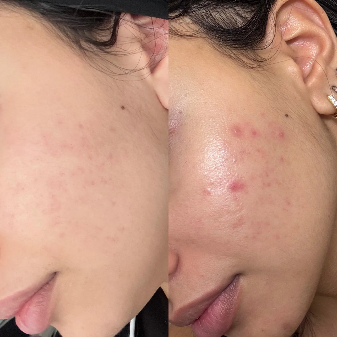 Niacinamide Before After 20 Visible Pores In 4 Weeks NOOANCE PARIS niacinamide-before-after-20-visible-pores-in-4-weeks-nooance-paris