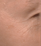 Close-up of skin with fine lines and wrinkles.