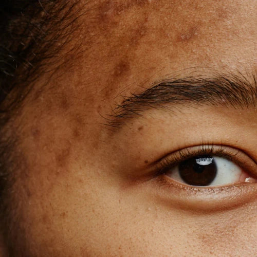 Elite Clear Skin Duo